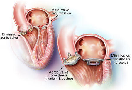 heart_valve_replacement03